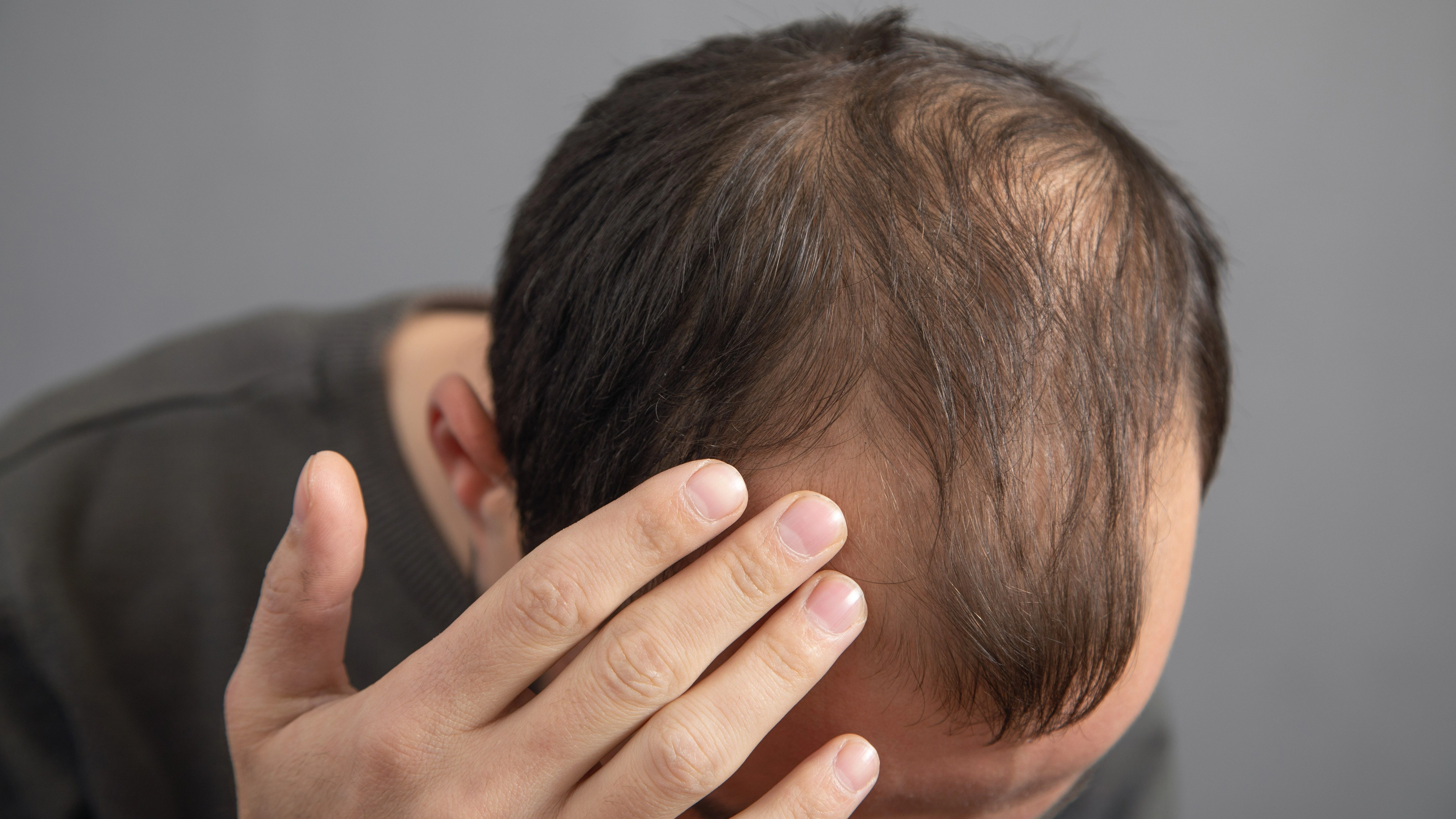 Hair Fall Treatment
